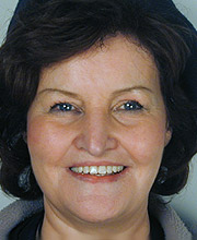 Patient after Dentalfacelift treatment